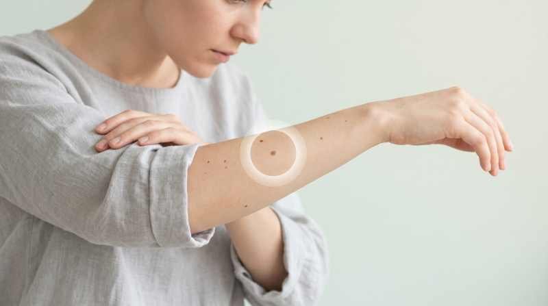 Câncer de pele: prevenção, diagnóstico precoce e cuidado com a vida